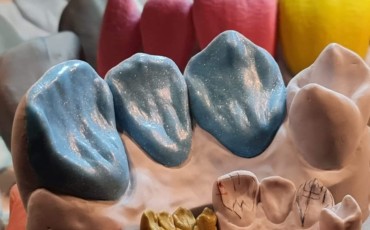 Estetyczne modelowanie zębów przednich